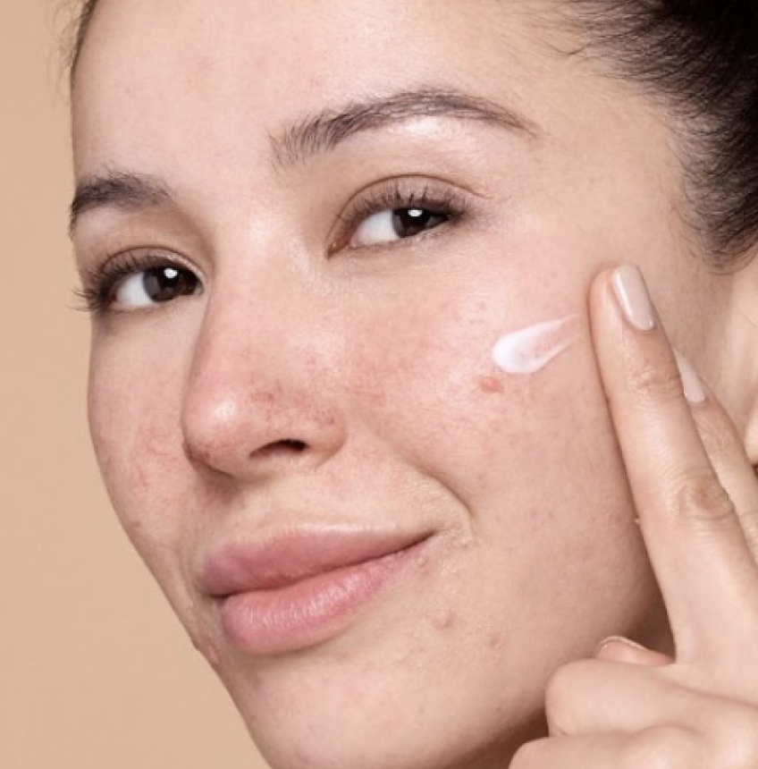 Woman with rosacea in her mid-30s putting pea-sized amount of EPSOLAY cream on left cheek