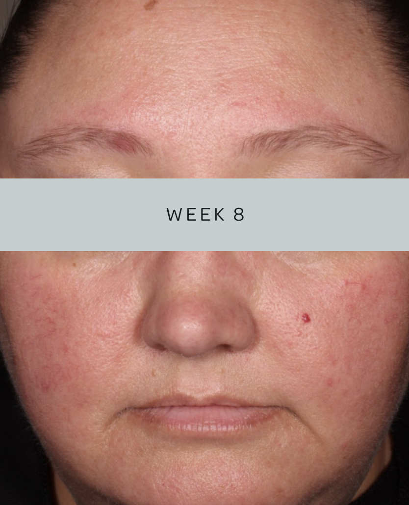 Patient 3, baseline and week 8